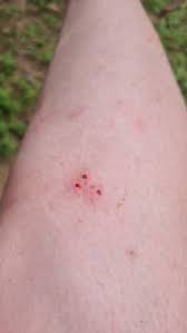 Image result for Spider Bite