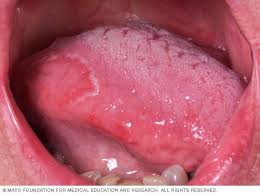 Image result for brown tongue symptoms