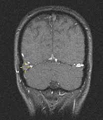 Symptoms and causes sinusvenenthrombose prophylaxis sinusvenenthrombose, medikamente, wirkungen, nebenwirkungen, risikocheck, arzneimittel im. Sinusthrombose Wikipedia