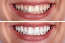 There are many ways and approaches, but the most solid solution is to keep a good cleaning routine and apply a reliable whitening product on your teeth some great techniques to whiten your teeth with braces. Teeth Whitening At Home Ava Orthodontics Invisalign