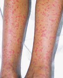 It may occur as a single event or subsequent bouts may cause further spread. Henoch Schonlein Purpura Consultant360