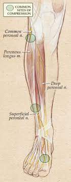 Pin On Nerve Pain In Leg From Back
