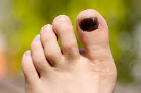 Why your knees hurt when running. 5 Tips To Prevent Black Toenails From Running Health Essentials From Cleveland Clinic