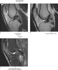 Image result for PCL Sulcus Test