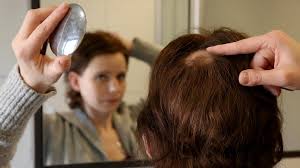 There is no cure for alopecia areata although some treatments are available to help hair regrow more. Junge Kirchehrenbacherin Kampft Gegen Mysteriose Krankheit Kirchehrenbach Nordbayern