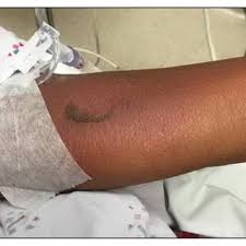 Image result for SCORTEN Score