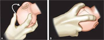 Image result for Manual Rotation in Occipitoposterior Presentation