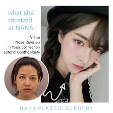 Before And After Plastic Surgery Korea Plastic Surgery V Line Surgery Real Model