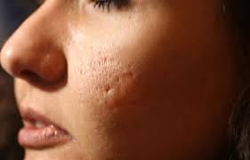 Kemunculan jerawat di wajah memang membuat kita kurang percaya diri. Cara Menghilangkan Bekas Jerawat Gloskin Banjarmasin