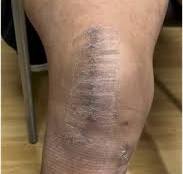 Knee valgus deformity: indications and outcomes for a high ...
