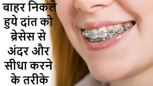 दांत कैपिंग प्रक्रिया के लिए इमेज परिणाम