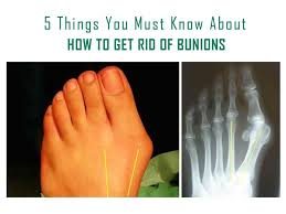 How To Get Rid Of Bunions 5 Easy Ways Footwear Boss Get Rid Of Bunions Bunion Rid