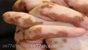 ( خروج البواسير اثناء التغوط ودخولها من تلقاء نفسها ). Ø§Ù„ÙØ±Ù‚ Ø¨ÙŠÙ† Ø§Ù„Ø¨Ø±Øµ ÙˆØ§Ù„Ø¨Ù‡Ø§Ù‚