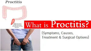 Image result for Proctitis