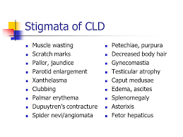 The american journal of clinical dermatology reports that palmar erythema is caused by blood vessel dilation in the hands. Chronic Liver Disease Multiple Causes Common Manifestation Ppt Download