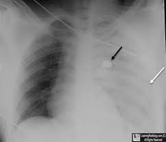 Learning Radiology Hemothorax