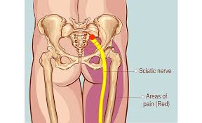 See full list on health.harvard.edu Piriformis Syndrome A Real Pain In The Butt South Vancouver Physiotherapy Clinic