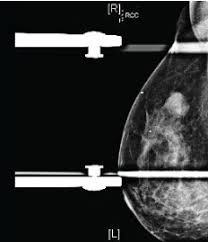 May also be used to screen for. Triple Negative Breast Cancer What Crucial Information Can Imaging Add To The Diagnosis Treatment And Prognosis