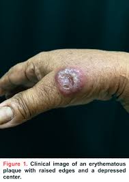 Image result for Pathergy