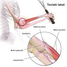 Ti mišići su smješteni na vanjskoj strani podlaktice i spojeni su tetivom na donji vanjski dio dio nadlaktične kosti koji se zove lateralni epikondil. Teniski Lakat Odgovori Na 10 Najcescih Pitanja Studio Kinetix