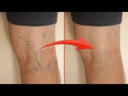 чем лечить варикозное расширение вен на ногах в домашних условиях Effektivnoe Lechenie Varikoza V Domashnih Usloviyah Youtube V 2020 G Varikoz Produkty Dlya Zdorovya Zdorove