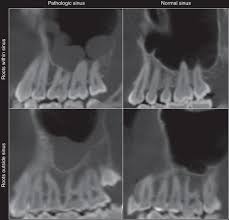 Image result for Maxillary Sinus