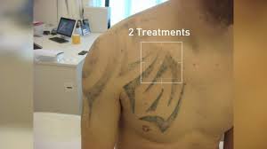 2020 picosure laser beauty machine nd yag laser tattoo remover picosecond laser freckles removal salon beauty equipment. Picosure Laser Tattooremoval Before And Afters Zapp Laser Studio Youtube