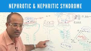 Nephrotic Nephritic Syndrome Causes Symptoms Treatment
