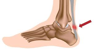 This is called achilles the achilles tendon connects your calf muscles to your heel bone. Achilles Tendonitis Diagnosis Treatment Rehabilitation Exercises