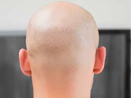 I dont want to say it was a hair because it was as hard as tough plastic, i could not bend it this topic is answered by a on my upper arm (always in the same spot) and a few days ago, i found one under my eye, high on my cheekbone. Alopecia Areata Causes Symptoms And Treatment