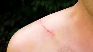 Image result for Skin Trauma