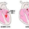 肺炎を起こすことがあります。 また，痛み止めを使いすぎると誤燕性肺炎を起こすこともあります。 肺塞栓症は，手術中に足の静脈の中に生じた血液の塊（血栓）が，血管壁からはがれて心臓を経て肺動脈に詰まることで起こります。 太い肺動脈に血栓が詰まると突然死することもあります。 長時間手. 1