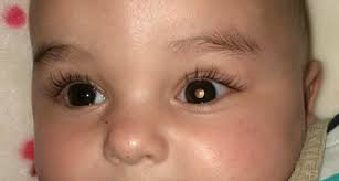 Eye cancer is very rare. Clinical Trial Of Sjd Barcelona In Childhood Retinoblastoma