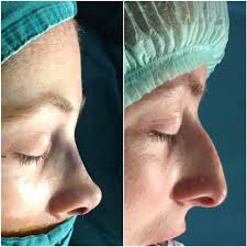 Bugunki Ameliyatimizi Tamamladik Ince Derili Hastalarda Iyilrsme Daha Cabuk Olur Burun Cizgi Ve Golgeleri Daha Fazla Goze Carpar H Rinoplasti Estetik Saglik