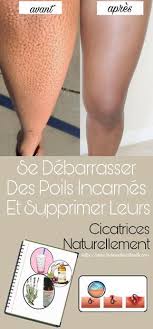 Les Poils Incarnes Sont Des Nouveaux Poils Qui Ont Devie De Leur Trajectoire Habituelle Et Qui Conti Poil Sous Peau Epilation Definitive Naturelle