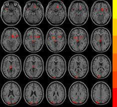 Short Term Effects Of Flupentixol Melitracen On Regional Brain Function In Patients With Irritable Bowel Syndrome An Fmri Study Iranian Journal Of Radiology Full Text Deanxit (flupentixol + melitracen) tablet. flupentixol melitracen