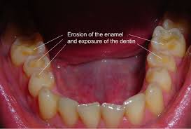 What is tooth erosion and is it dangerous? | Acharya Dental