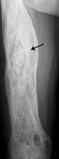 Image result for Osteomyelitis