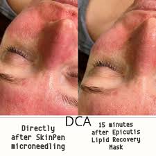 Going live at dimension cool aesthetics with some micro needling. Dimension Cool Aesthetics Post Skinpen Microneedling Session Absolutely Love Using The Epicutis Lipid Recovery Mask After Treatments To Help Calm And Soothe The Skin We Are Also Loving The
