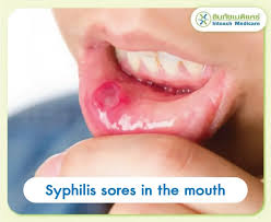 Image result for syphilis ulcer