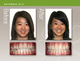 Typically overbite or underbite correction is a process that will take between 2 and 3 years and involves 2 stages of orthodontic procedures, and orthognathic surgery, and possibly even traditional veneers and crowns to get the correct bite and look for a patient. Before And After This A Rare Case Where We Were Able To Fix An Underbite Without Jaw Surgery Http Gregjorgensen Orthodontics Affordable Braces Jaw Surgery