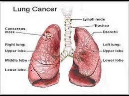 Lung cancer claims more lives each year than do colon, prostate, ovarian and breast. Signs Of Lung Cancer Youtube
