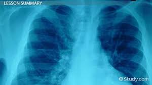 Image result for Hemothorax