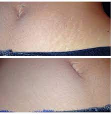 Veil Cover Cream How To Hide Stretch Marks