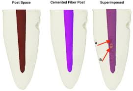 Endodontic post crown bridge restoration on abutment inlay onlay veneer, tabletop maryland and inlay/onlay bridge 1 priming not required for 3m™ relyx™ fiber posts | 2 alternative primer: Micro Computed Tomography Analysis Of Gap And Void Formation In Different Prefabricated Fiber Post Cementation Materials And Techniques Sciencedirect