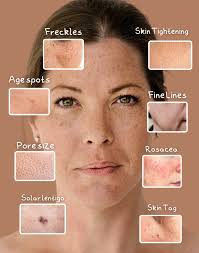 Image result for Solar Lentigo