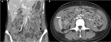 Image result for Neutropenic Colitis