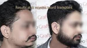 Best beard transplant