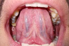 Image result for Sublingual Varices