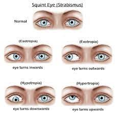 Maybe you would like to learn more about one of these? Squint Eye Treatment For Children Pediatric Ophthalmology For Surgery
